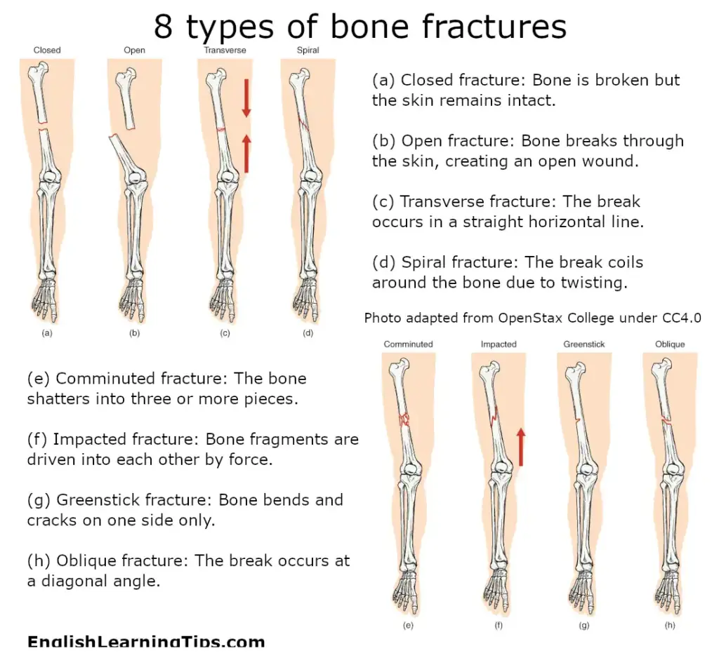 A medical diagram illustrating eight types of bone fractures including closed, open, transverse, spiral, comminuted, impacted, greenstick, and oblique.
